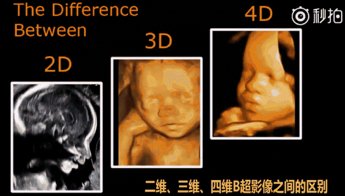 普通B超、彩超、三维、四维有啥区别？NT必须做吗？孕妈妈看！